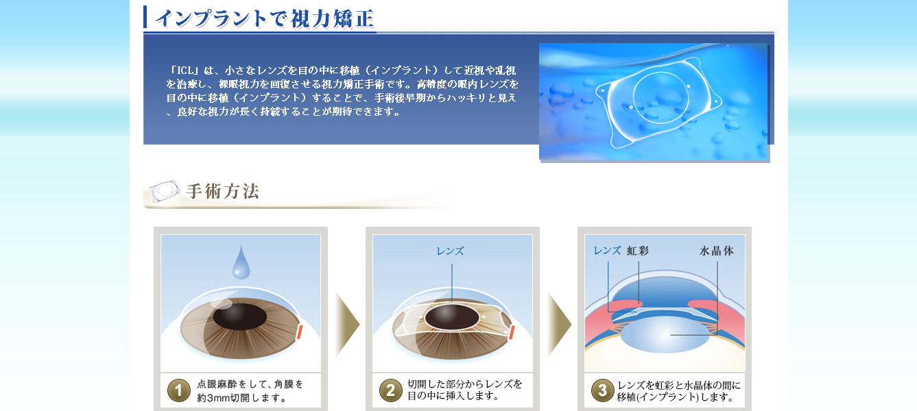 インプラントで視力矯正│ICL（アイシーエル）情報サイト ICLとは？